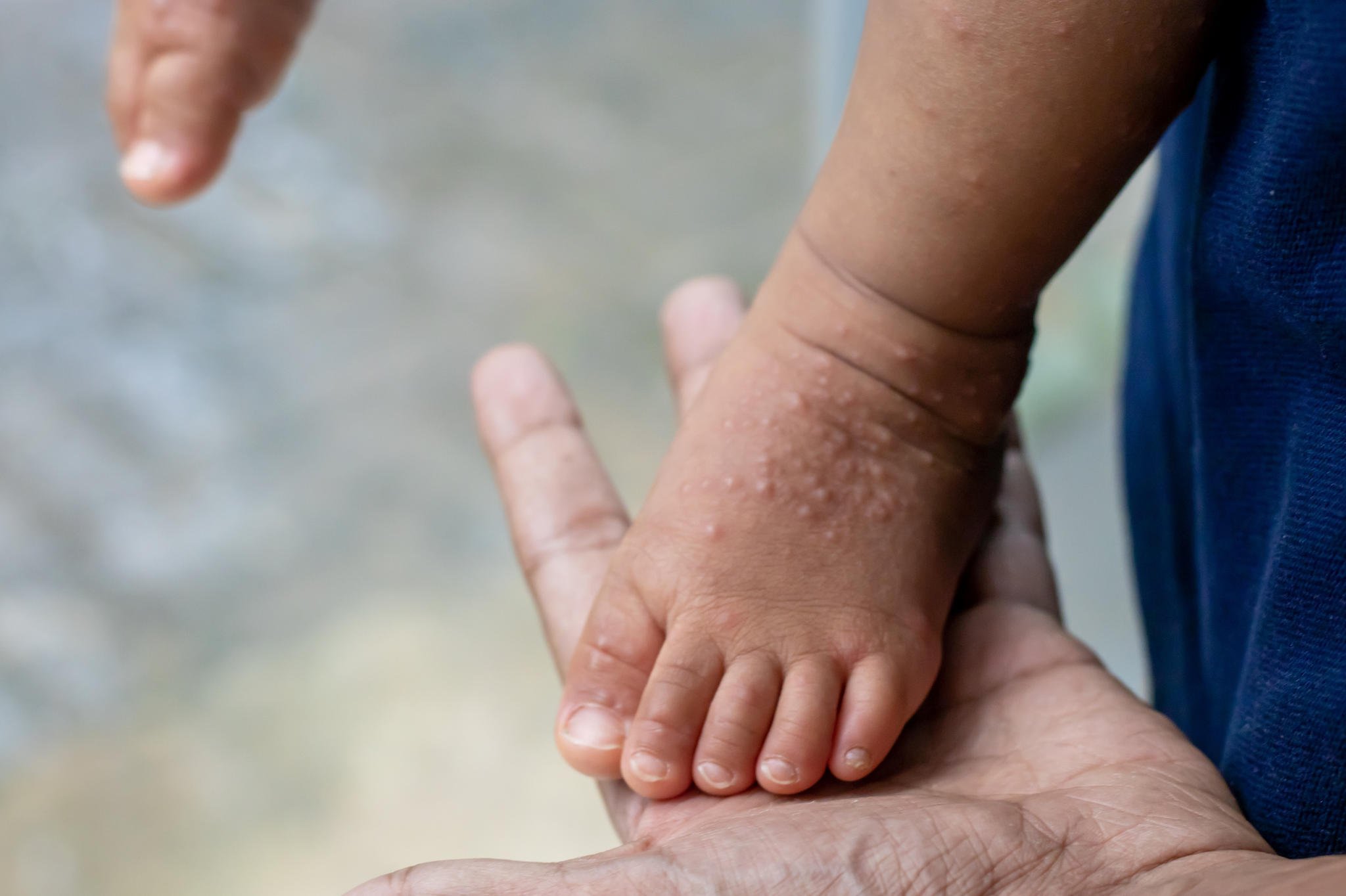 Doença Mão-Pé-Boca: o que é, sintomas e como cuidar do seu filho