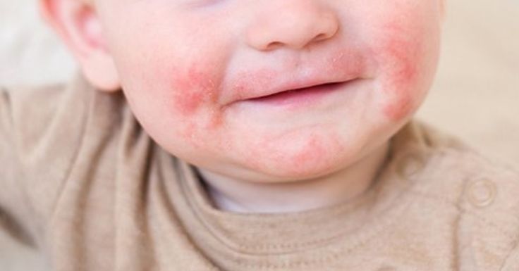 Cuidados com alergias e infecções na infância